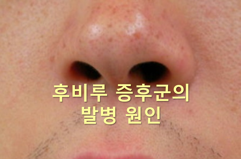  후비루 자가치료 방법과 후비루 증후군 코세척 효과