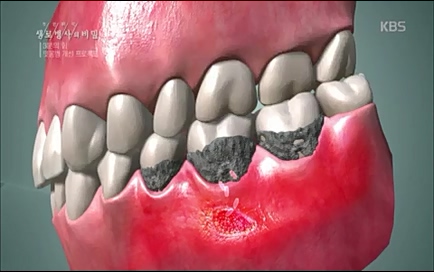[670회] 생로병사의 비밀 - KBS670회] 생로병사의 비밀.ts_20220505_143205.528.jpg