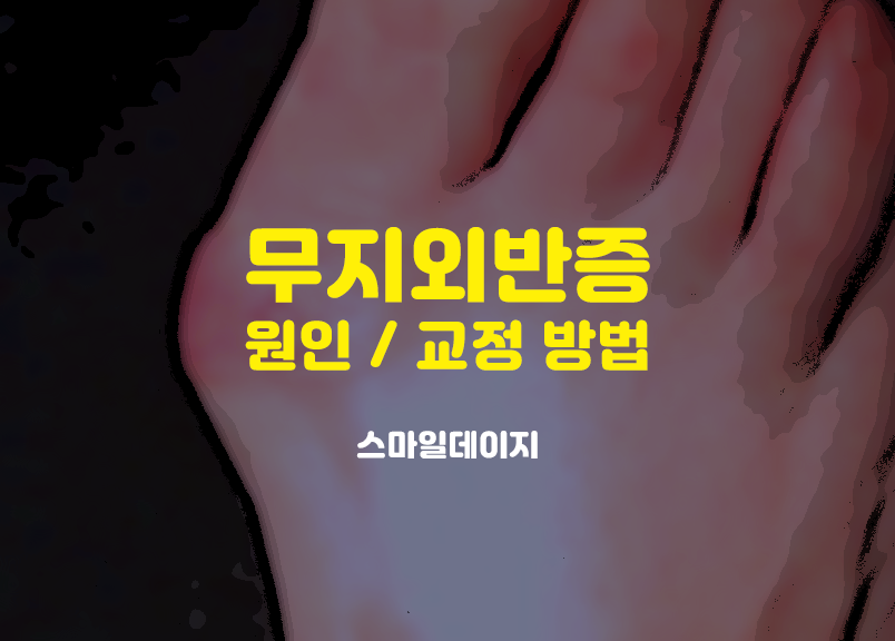  발가락 뼈 무지 외반증 원인 교정방법 알아보기