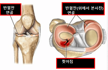 정상 반월판 연골 및 손상된 연골 사진
