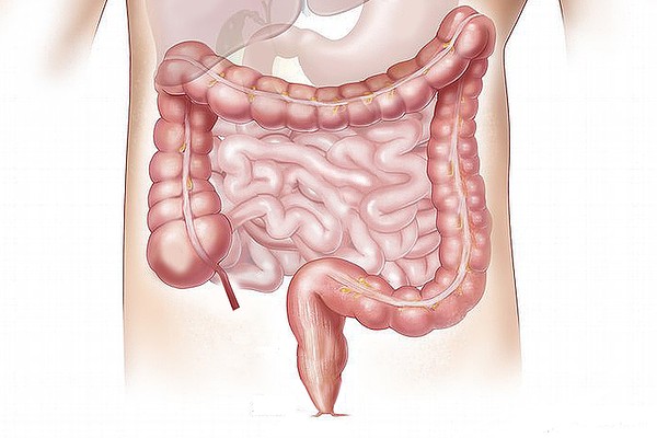  대장암 초기 증상 원인 - 배변습관 잔변감 검은변