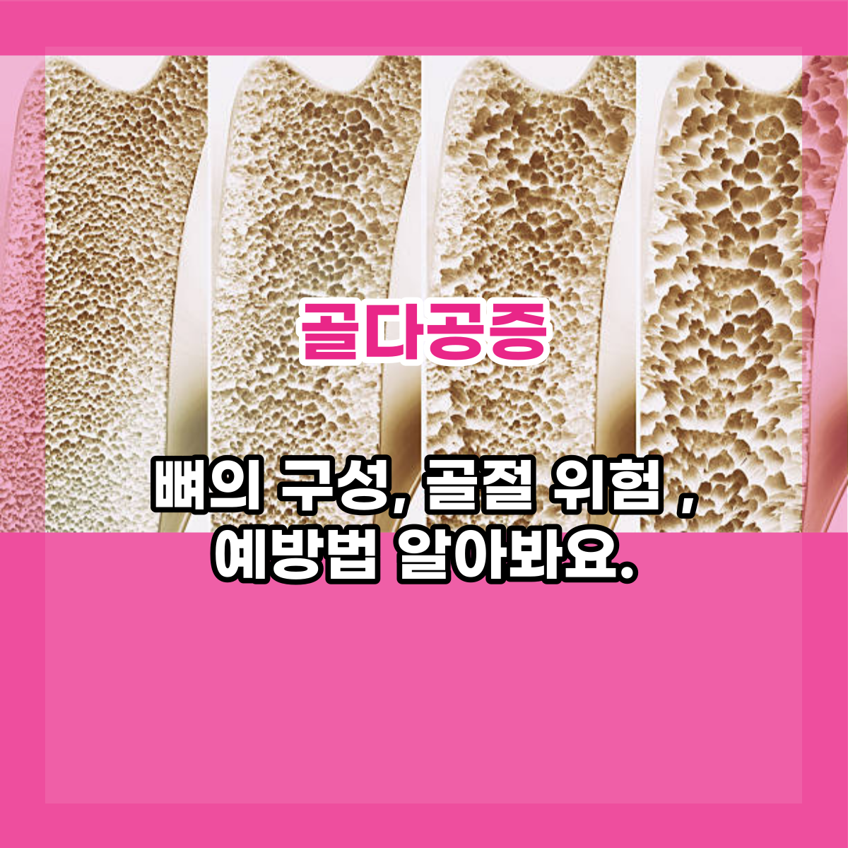  골다공증 예방법, 여성이라면 미리 예방해야 합니다.