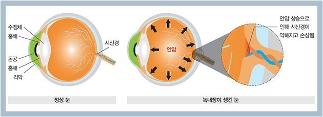 녹내장