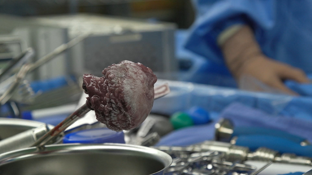 EBS 826회 명의 고관절 질환 - 인공관절로 걷다, 수술 후 합병증, 부작용 및 생활 관리, 퇴행성 관절염, 골절, 대퇴골두무혈성 괴사 치료 방법 강북 삼성병원 박윤수 박재형 교수