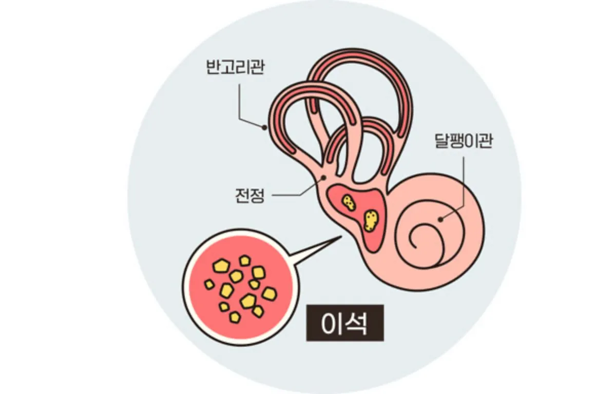 이석증 원인과 치료방법