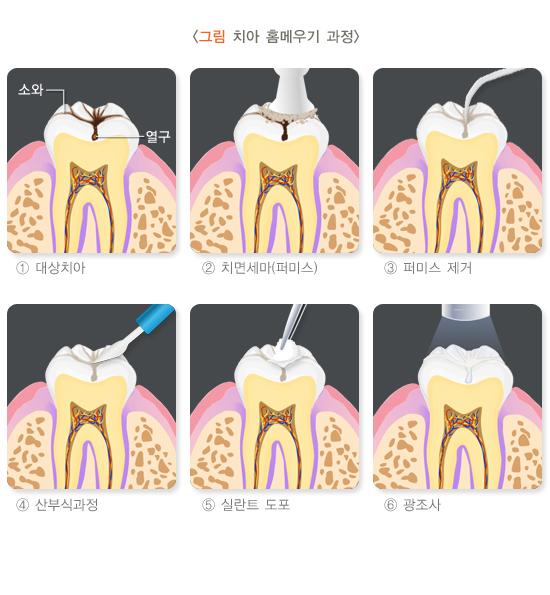 치아홈메우기-치료과정-썸네일
