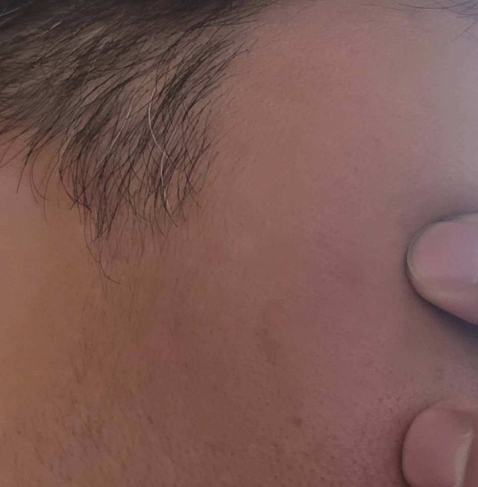 바늘로 찌르는 통증, 편두통이 심할 때 지압하면 효과가 있을까? 4