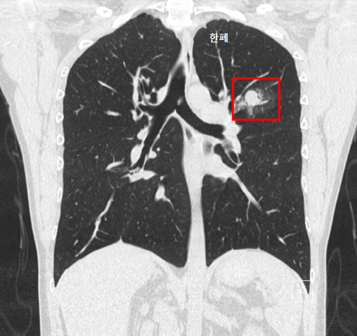 폐 종양 폐 결절 CT 사진