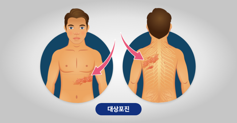 대상포진 증상. 치료