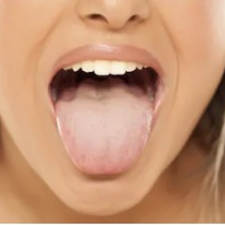 혀 따끔 거림 증상