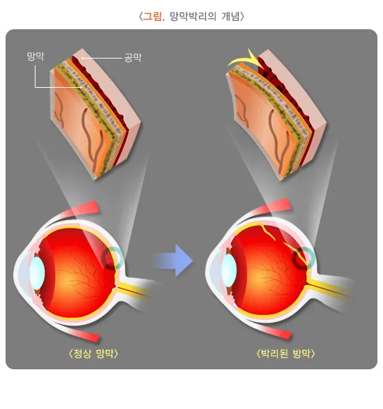 망막박리 개념