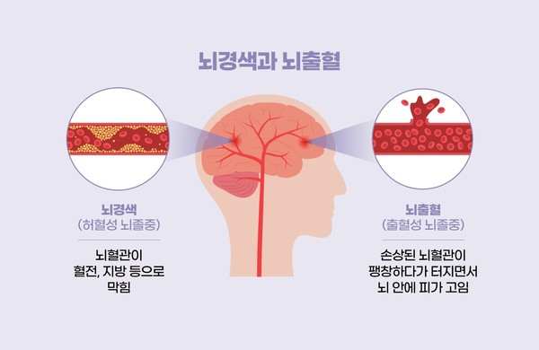뇌경색과 뇌출혈