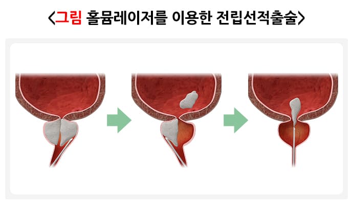 전립선비대증