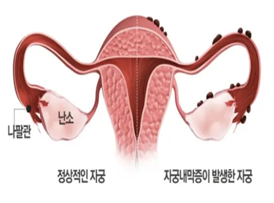 자궁내막증-자궁사진
