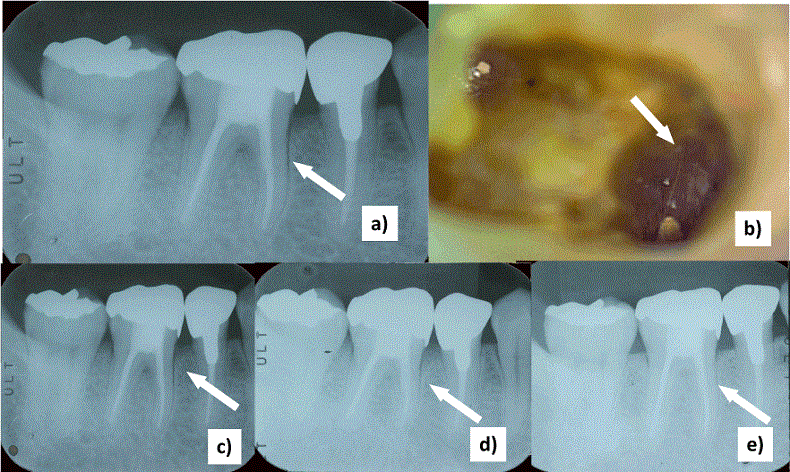 미국 최초 신경 치료 후 치아의 생존기간 분석 First U.S. study analyzing tooth survival after root canal in general population