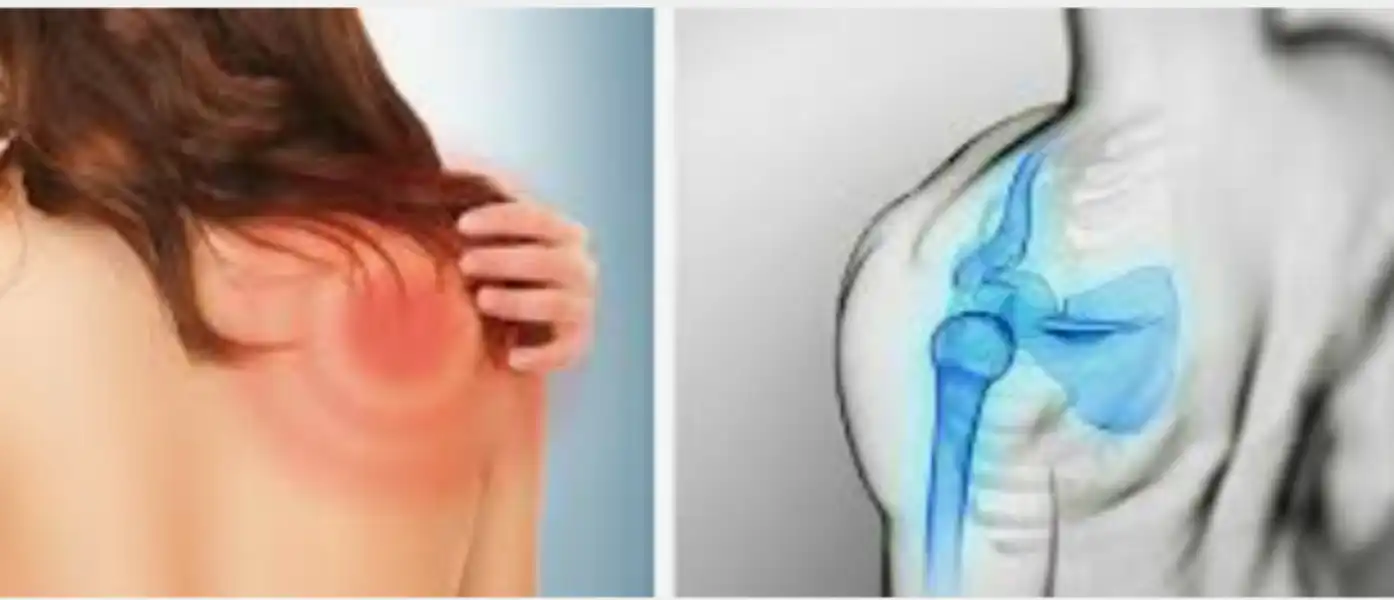 어깨통증 치료법