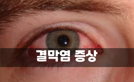  결막염증상에는 어떤 것들이 있을까? 예방법까지 알아보자