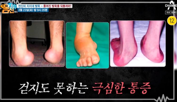 나는 몸신이다 324회 다시보기 재방송 틀어진 발목 테이핑