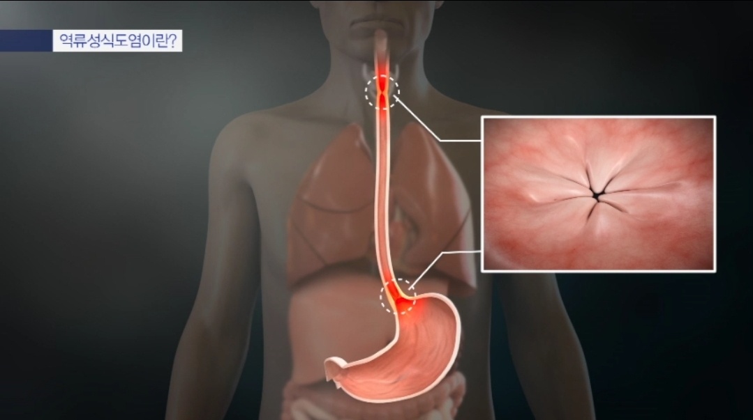 타는 듯한 가슴 통증 역류성식도염 명의