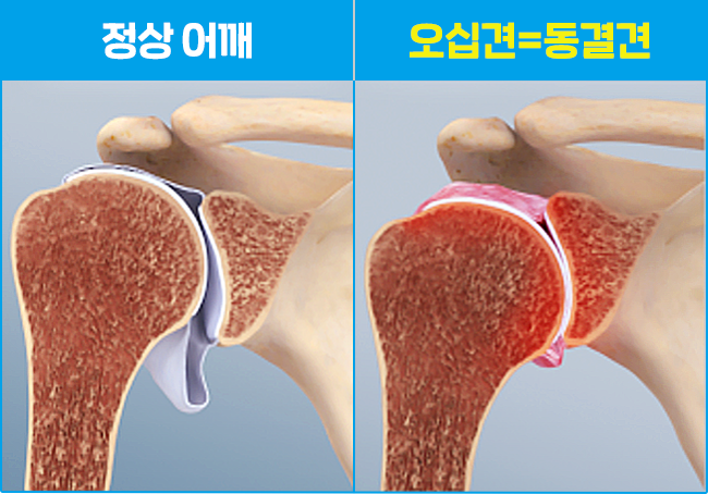 치료방법을 알아봅니다.부천 오십견의 원인과