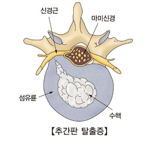 허리디스크 초기 증상