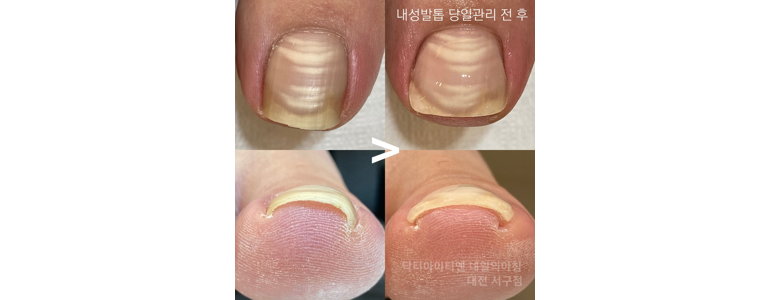 대전 중구 각질