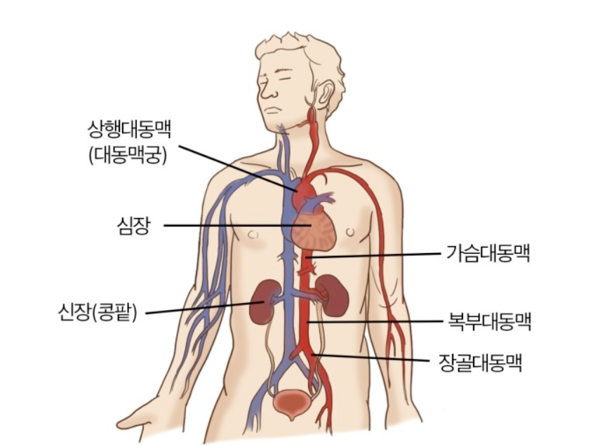 대동맥 박리