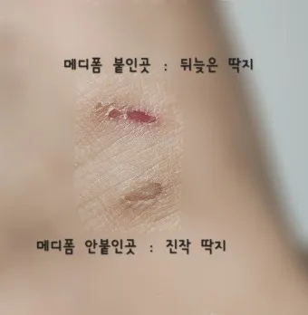 메디폼 종류 및 사용법 주의사항_7