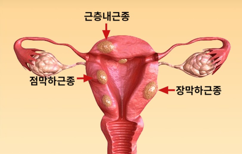 자궁 근종