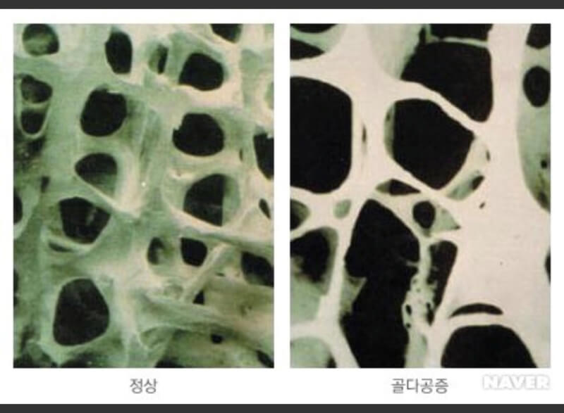  골다공증에 좋은 영양제