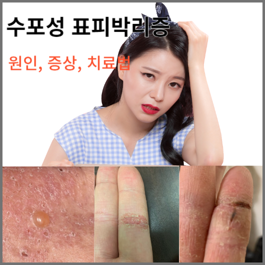 수포성 표피박리증 원인 증상 치료법