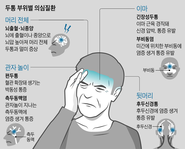  편두통 원인 및 증상 치료법 총정리