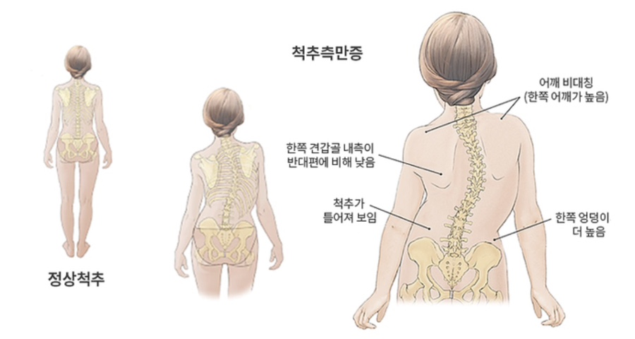 척추측만증 비교자료