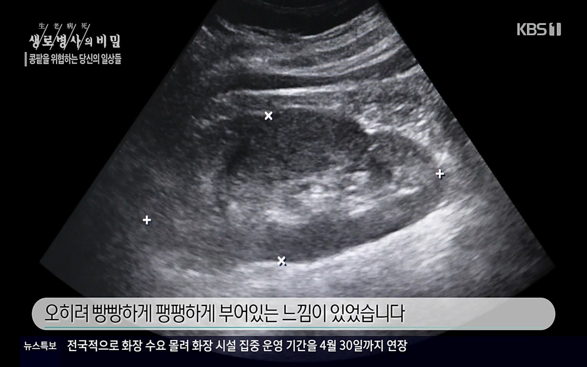 생로병사의 비밀.E819.220421p-NEXT.mp4_20220421_191224.932.jpg