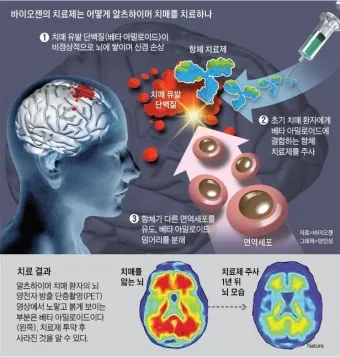 알츠하이머와 치매 차이_16