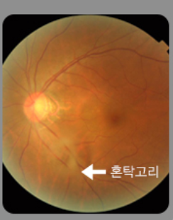 비문증 자연치료 8