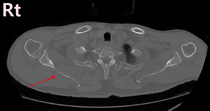 Shoulder Axial Scan