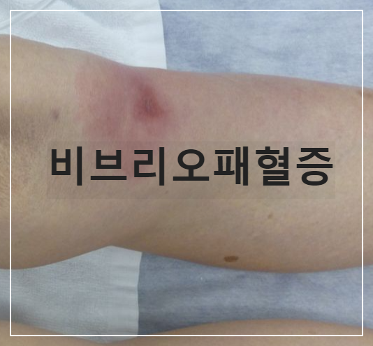 급성패혈증
