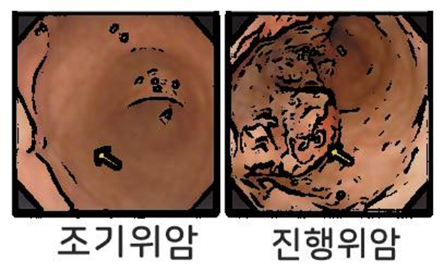 조기위암-진행위암