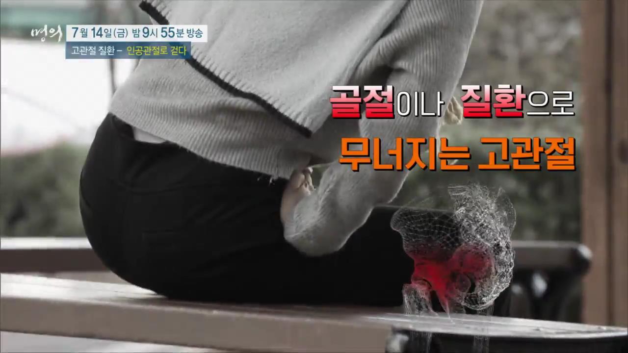 EBS 826회 명의 고관절 질환 - 인공관절로 걷다, 수술 후 합병증, 부작용 및 생활 관리, 퇴행성 관절염, 골절, 대퇴골두무혈성 괴사 치료 방법 강북 삼성병원 박윤수 박재형 교수