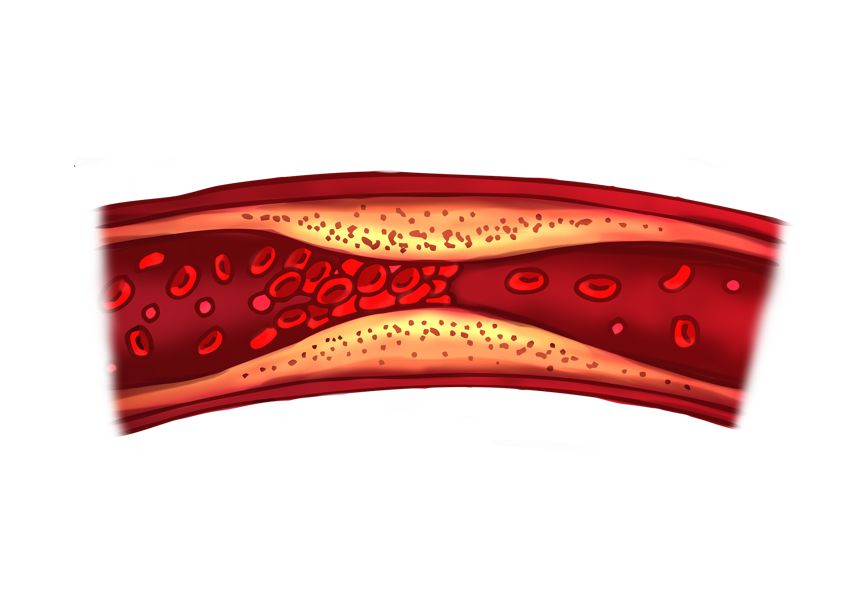 막힌 혈관 그래픽