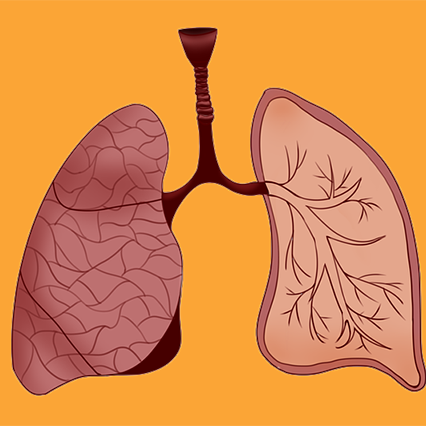폐렴치료