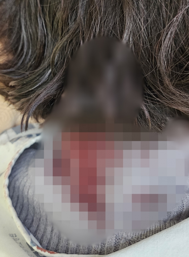 배현진 의원 피습 당시 옷에 묻은 혈흔.