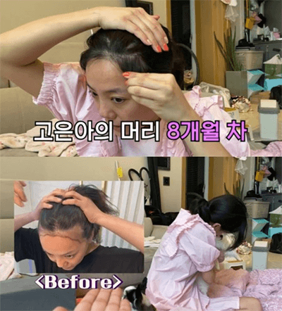  모발이식 비용 500~5,000모 가격 정리, 부작용, 후기