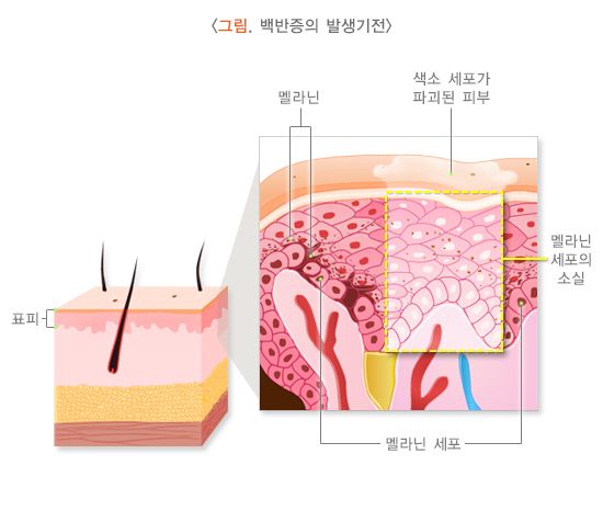 백반증 증상