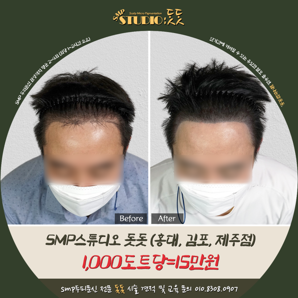  남자 앞머리 탈모 두피문신으로 밀도 올리기