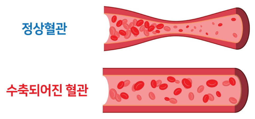 심뇌혈관 질환, 예방법은? 겨울철 주의해야 할 8