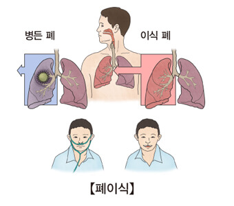 병든-폐와-이식한-폐를-그린-설명그림