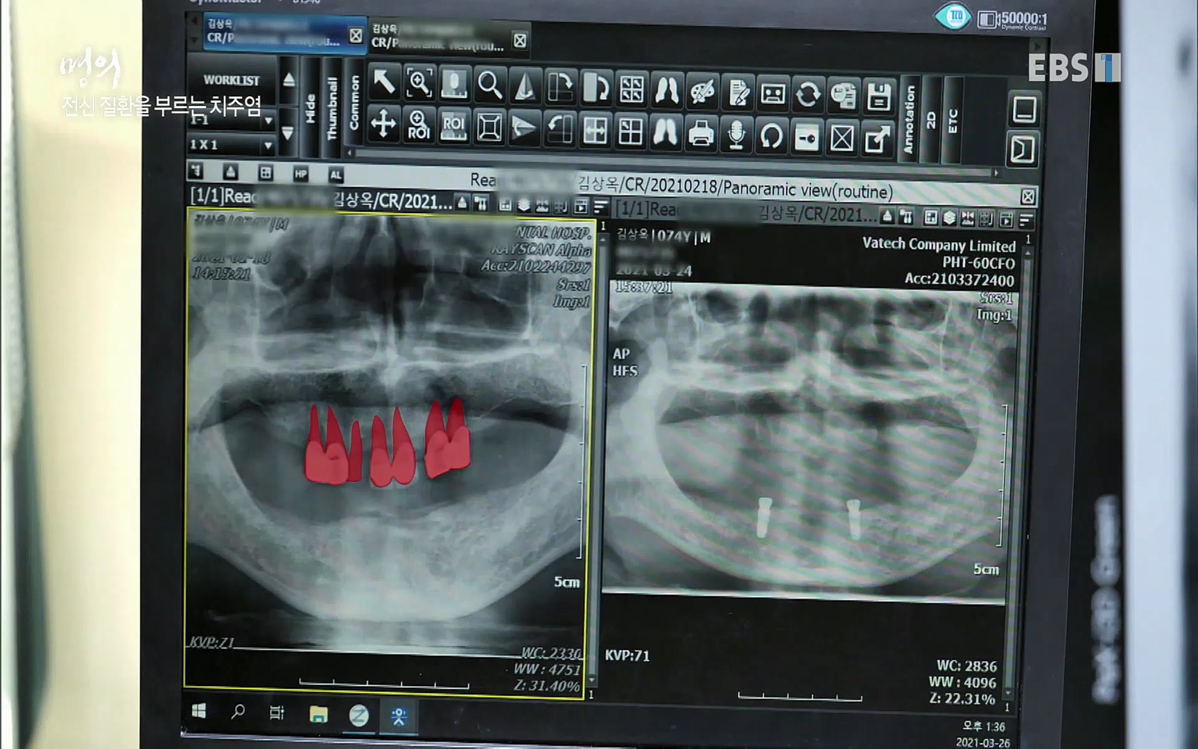 EBS 명의 헬스케어 - TV - 교육의 중심 EBS치주염이 코로나로 소홀해진 구강관리가 치아를 더 망가트리고 위험하게 만들며, 증상이 없기 때문에 특히 더 조심하고 치은염 단계에서 진행되지 않도록 예방해야한다 정의원 교수님과 치_20220505_151717.836.jpg