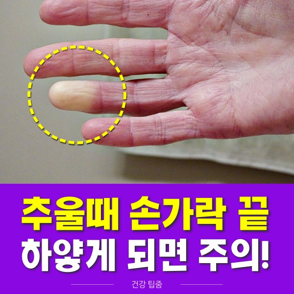 추울때 손가락 끝이 하얗게 변하는 레이노 증후군 증상 관절염 루푸스